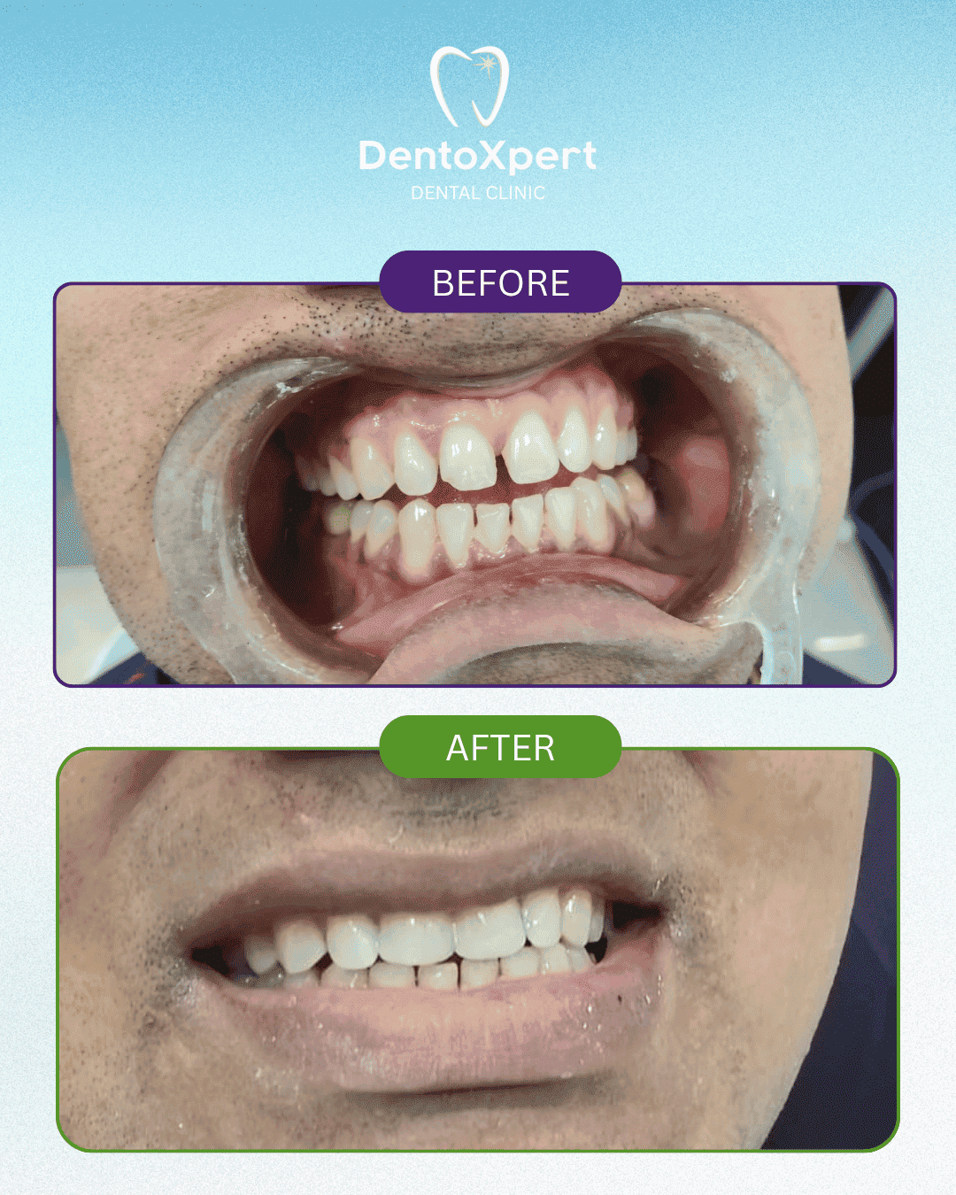 Before and after dental treatment result at DentoXpert Dental Clinic in Thane